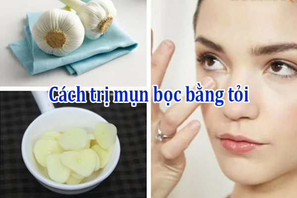 Cách trị mụn bọc bằng tỏi
