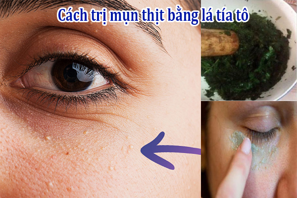 8 Cách trị mụn thịt bằng lá tía tô tại nhà hiệu quả 1 Cách trị mụn thịt bằng lá tía tô