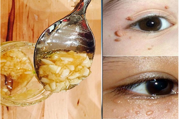Cách trị mụn thịt bằng tỏi