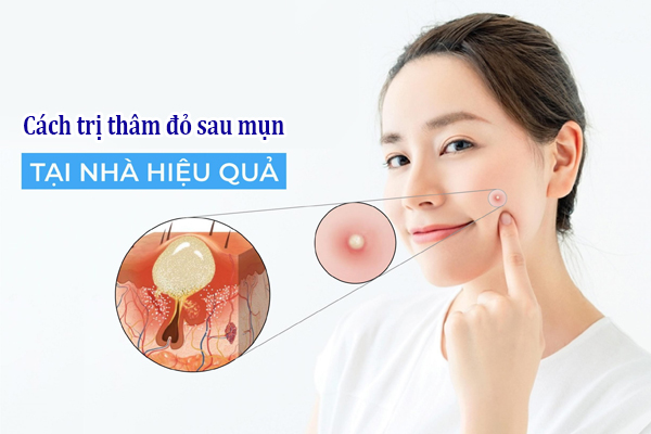 Cách trị thâm đỏ sau mụn nhanh nhất tại nhà chỉ với 15 công thức đơn giản 1 Cách trị thâm đỏ sau mụn