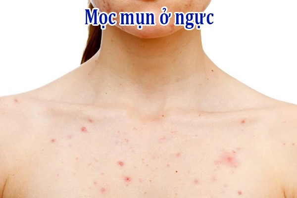 Mọc mụn ở ngực