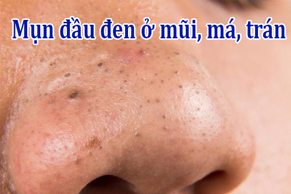 Mụn đầu đen ở mũi, má, trán