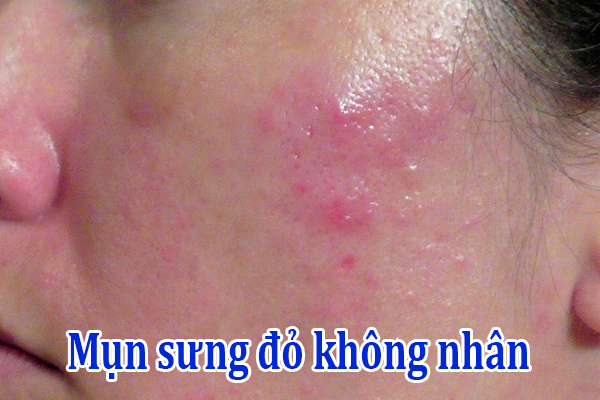 Mụn sưng đỏ không nhân