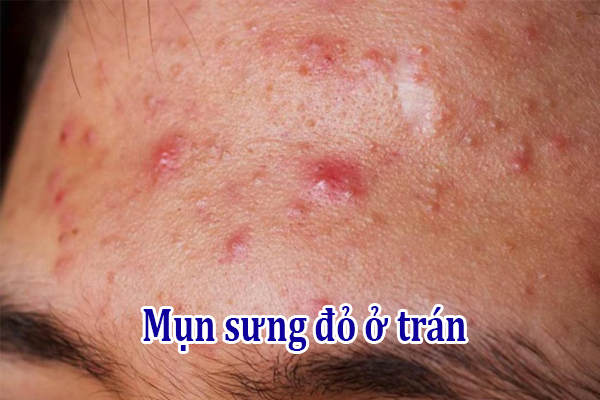 Mụn sưng đỏ ở trán