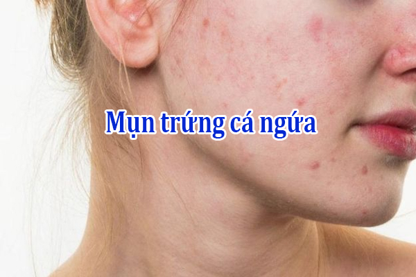 Mụn trứng cá ngứa