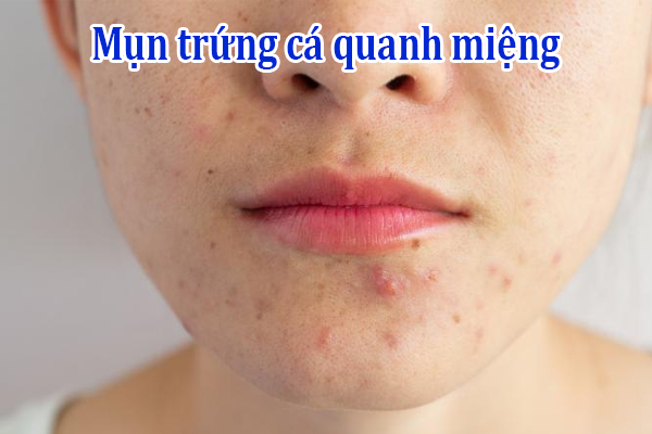 Mụn trứng cá quanh miệng: Nguyên nhân và cách khắc phục hiệu quả 1 Mụn trứng cá quanh miệng