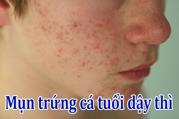 Mụn trứng cá tuổi dậy thì