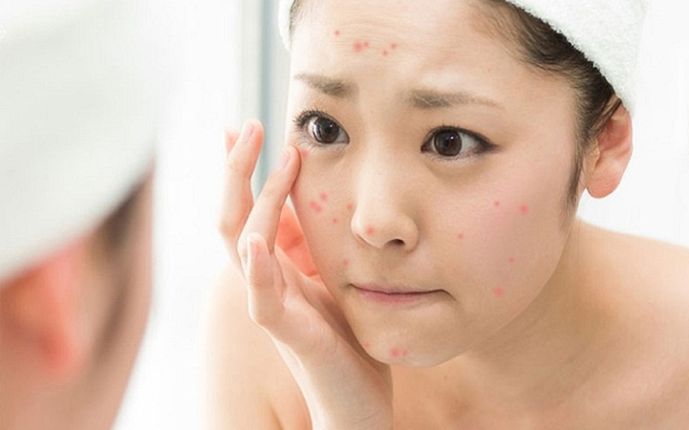 Mụn trứng cá ở tuổi dậy thì được chia ở nhiều giai đoạn nặng, nhẹ khác nhau
