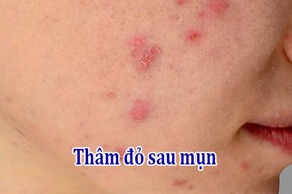 Thâm đỏ sau mụn: Nguyên nhân và cách điều trị hiệu quả nhất 1 Thâm đỏ sau mụn