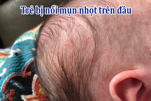Trẻ bị nổi mụn nhọt trên đầu nguyên nhân do đâu