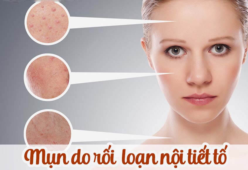 Mụn nội tiết là gì