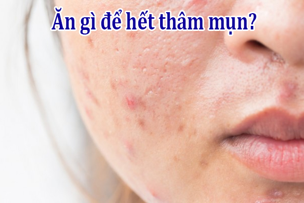 Nên ăn gì để hết thâm mụn?
