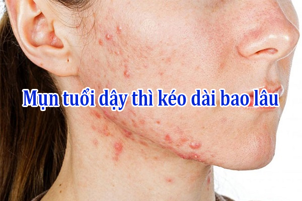 Mun tuoi day thi keo dai bao lau