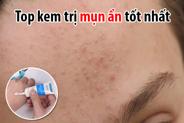 Top 5 kem trị mụn ẩn tốt nhất hiện nay