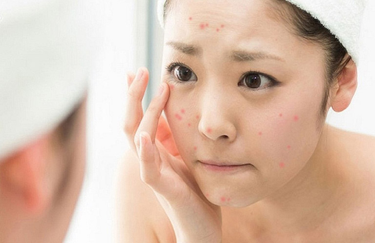 Có nên sử dụng kem trị mụn thâm hay không