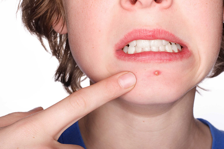Mụn trứng cá quanh miệng: Nguyên nhân và cách khắc phục hiệu quả 3 mun trung ca quanh mieng 3