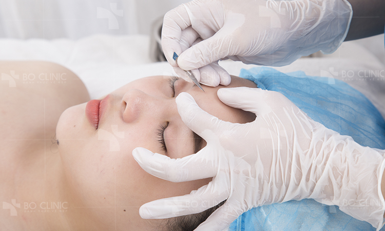 Mụn bọc không đầu là gì? Cách điều trị dứt điểm 6 Dung kim tiem de chich mun