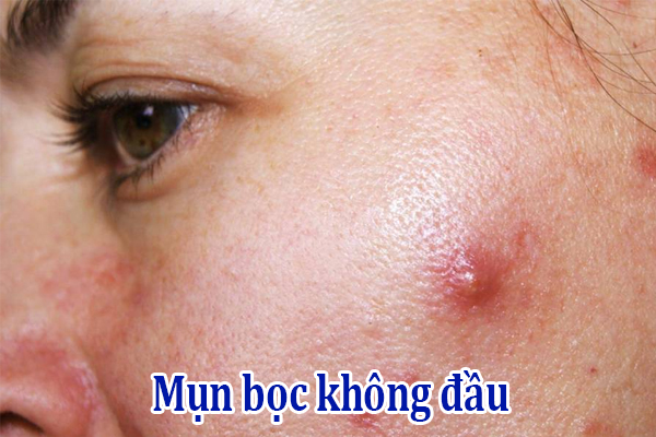 Mụn bọc không đầu là gì? Cách điều trị dứt điểm 1 Mun boc khong dau