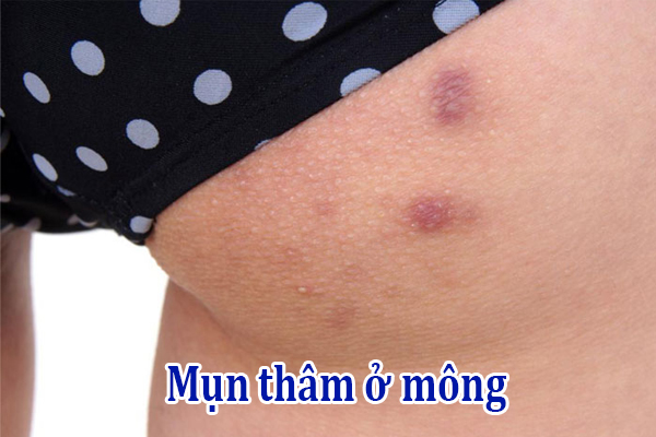 Điều trị mụn thâm ở mông như nào để mang lại hiệu quả.