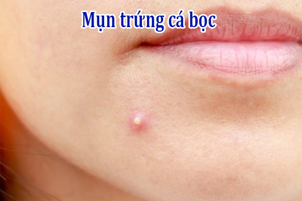 Mụn trứng cá bọc là gì?