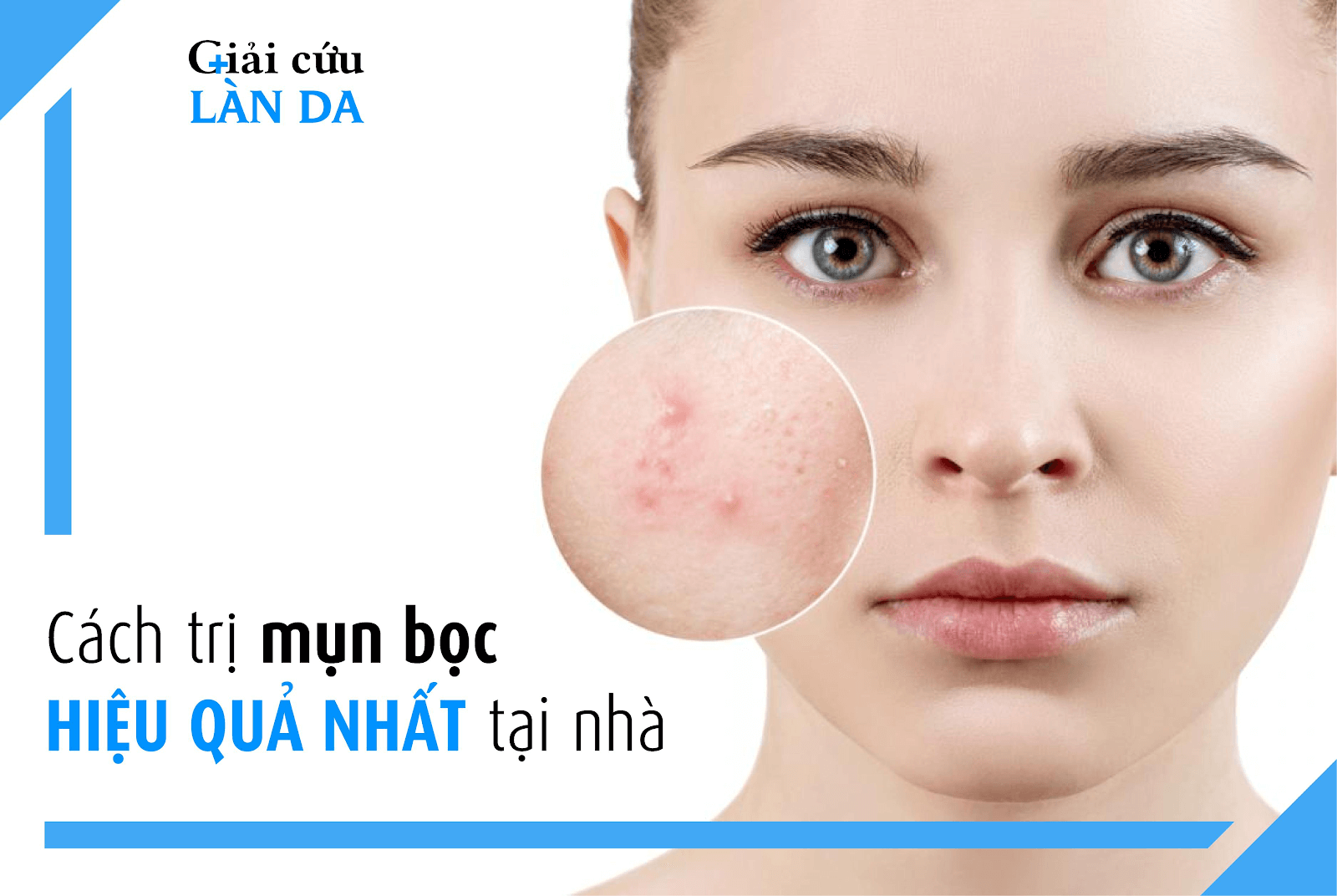 Tìm hiểu phương pháp trị mụn trứng cá bọc hiệu quả tại nhà.