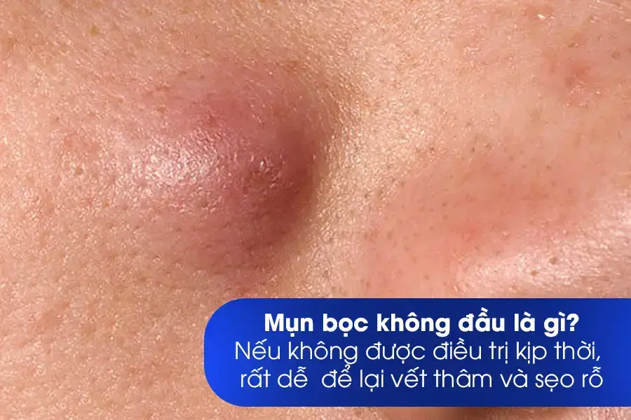Mụn bọc không đầu là gì? Cách điều trị dứt điểm 2 Nguyen nhan gay ra mun boc khong dau