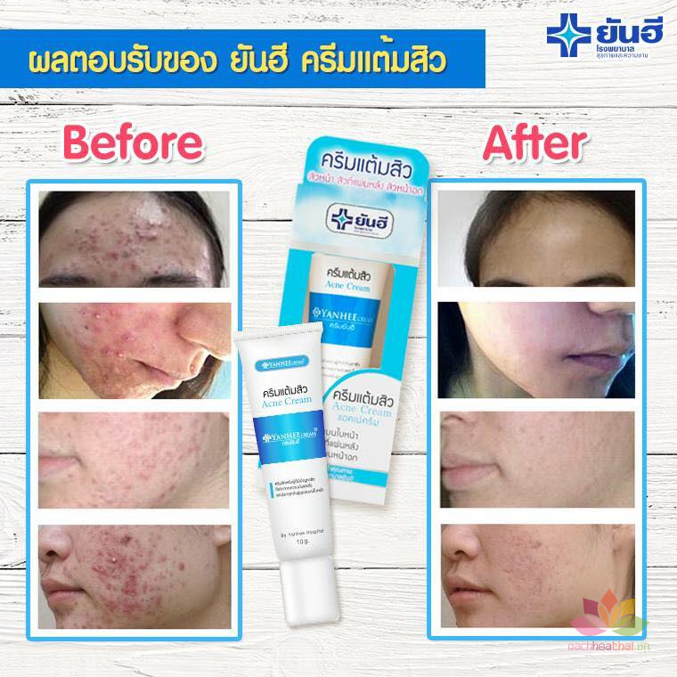 18 cách trị mụn bọc sưng đỏ tại nhà an toàn, hiệu quả 9 Yanhee Acne Cream