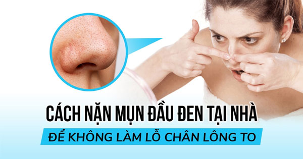 Nặn mụn đầu đen nên hay không? Hướng dẫn cách nặn mụn đầu đen đúng cách 2 nan mun dau den