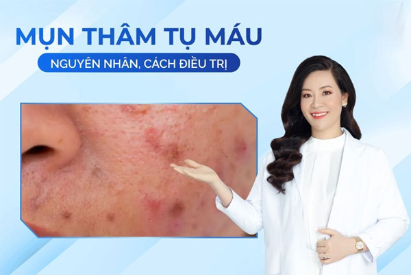 Mụn thâm tụ máu: nguyên nhân và cách điều trị tại nhà 2 nguyen nhan mun tham