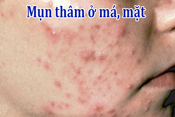 Mụn thâm ở má mặt là gì?