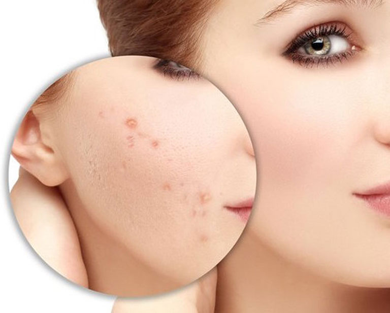 Có nhiều nguyên nhân gây ra tình trạng mụn thâm sau mụn.
