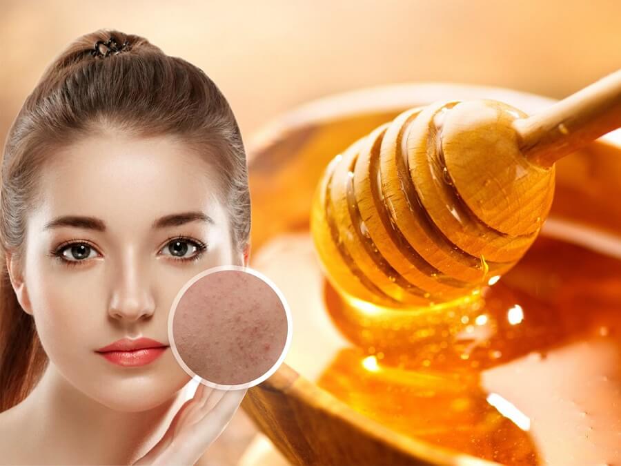 12 cách trị mụn thâm đỏ tại nhà hiệu quả bạn có thể áp dụng 5 Mật ong hỗ trợ kháng viêm, dưỡng trắng da tăng hiệu quả trị mụn.