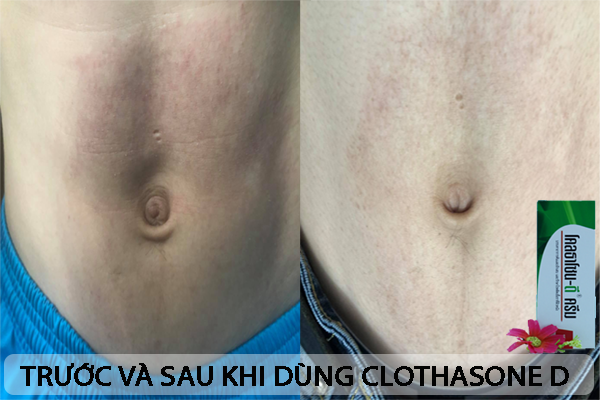 Review thuốc trị nấm da Clothasone D Thái Lan có tốt không? 3 Hiệu quả của Clothasone D Thái Lan được các chuyên gia đánh giá cao