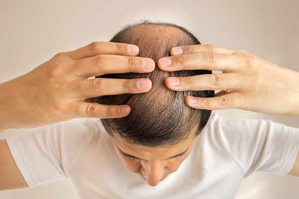 Hói đầu là biến chứng phổ biến của rụng tóc