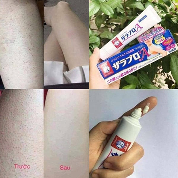 Kết quả sau khi sử dụng kem Zaraporo trị viêm nang lông