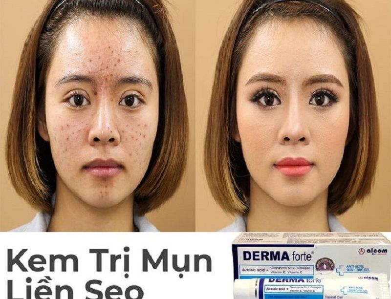 Kem tri mun Derma duoc danh gia la mang lai hieu qua chi sau 3 ngay su dung
