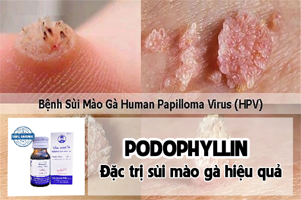 Podophyllin đặc trị sùi mào gà ở nam và nữ