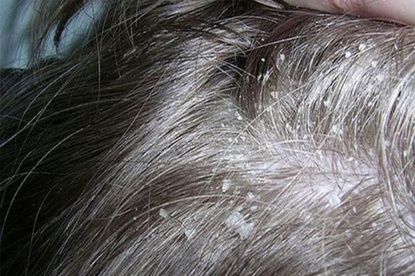 Bệnh nấm da đầu có lây không? 1 Nấm da đầu có khả năng lây lan bất kể nguyên nhân nào.
