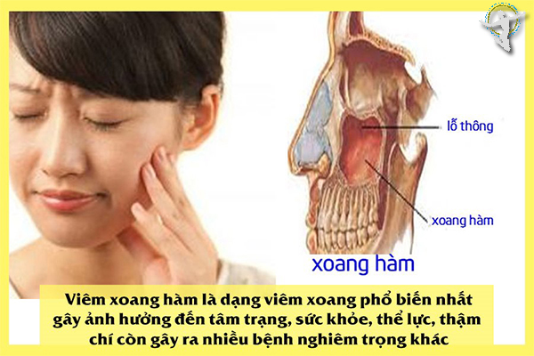 Bệnh viêm xoang hàm Bệnh viêm xoang hàm