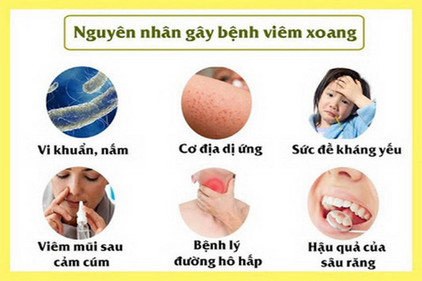 Viêm xoang hàm là gì? Nguyên nhân, triệu chứng, cách điều trị 1 Các nguyên nhân chính gây viêm xoang hàm