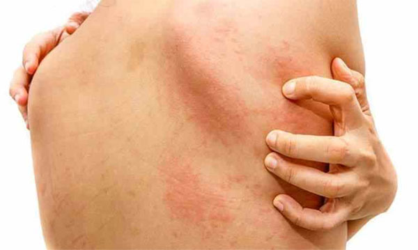 Mề đay mãn tính là tình trạng bệnh dai dẳng và tái đi tái lại nhiều lần