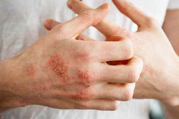 Bệnh chàm là biến chứng của mề đay mãn tính