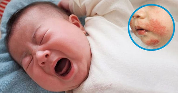 Thuốc Genskinol: Thành phần, Tác Dụng, Chống Chỉ Định 2023 4 Thận trọng khi dùng thuốc cho bé, hạn chế bôi vào các vị trí nhạy cảm như mắt, miệng