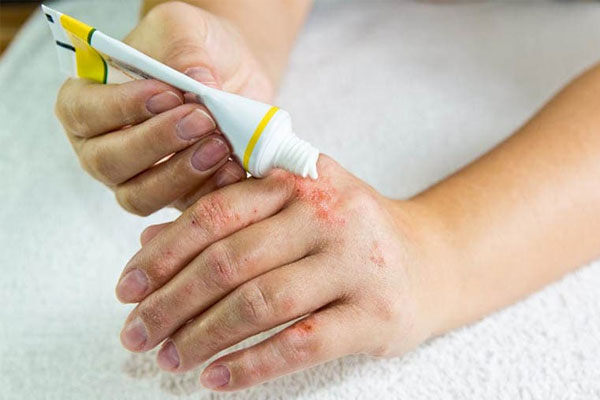 Thuốc trị chàm hiệu quả Takazex