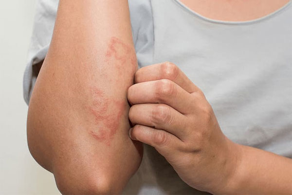 Thuốc được sử dụng để điều trị các bệnh ngoài da như chàm, vảy nến, v.v.