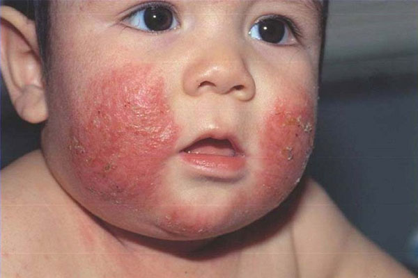 Bé bị chàm sữa dùng gì đừng quên Takazex