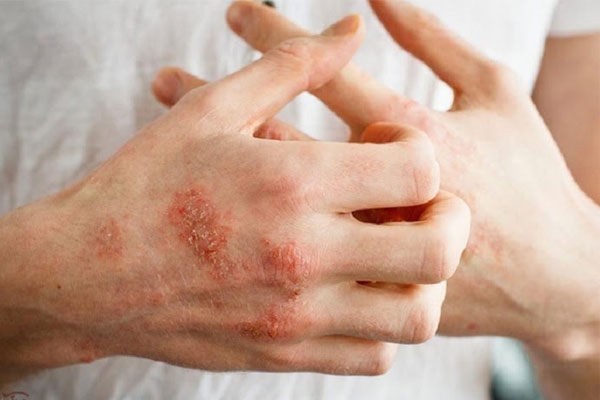 Bệnh thường xuất hiện ở một vùng trên cơ thể như tay, chân,..