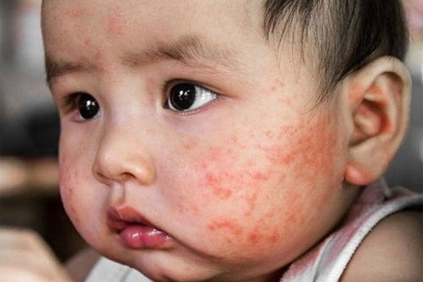 Bệnh chàm ở trẻ nổi nhiều mụn nước nhỏ, có dịch