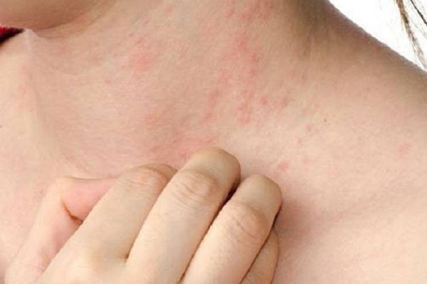 Ở giai đoạn đầu bệnh chỉ đơn thuần là các nốt ban đỏ, dễ nhầm lẫn với các bệnh ngoài da khác.