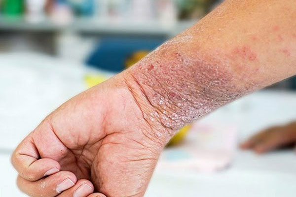Bệnh không lây nhiễm nhưng bệnh kéo dài sẽ ảnh hưởng nghiêm trọng đến thẩm mỹ và tâm lý